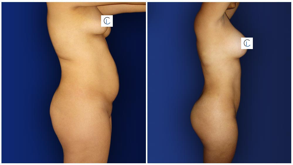 0-march-tummytuck-6
